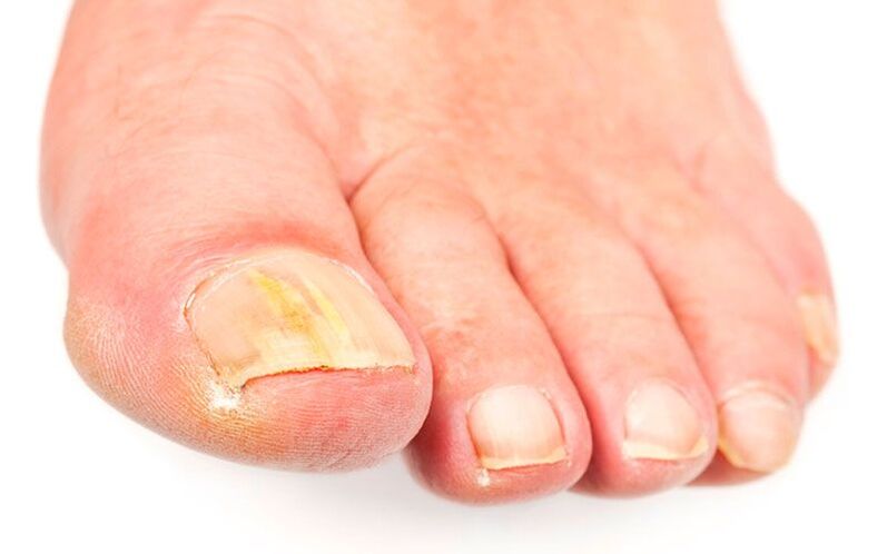 Causes of the fungus