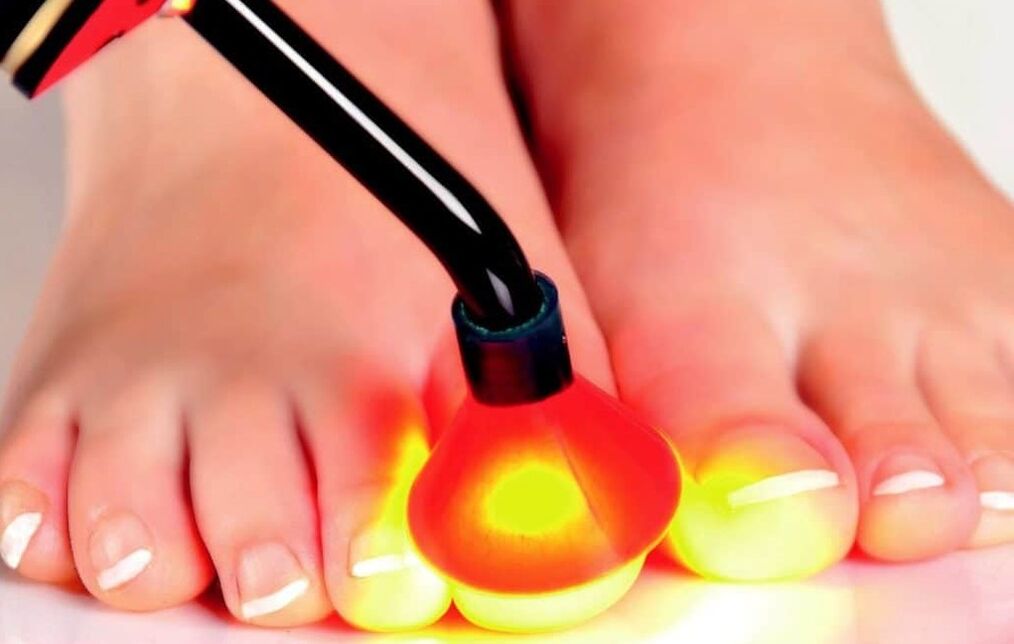 Laser nail plate treatment
