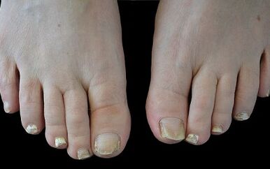 How to get rid of the mushroom on your fingers