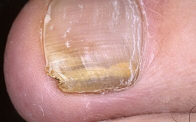 Manifestations of the fungus on the thumb leg