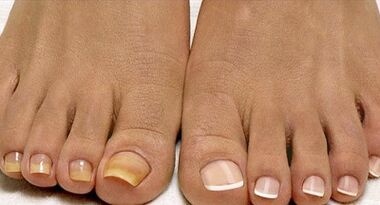 Fungus fleet treatment methods