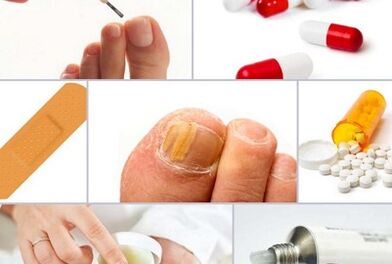 How to treat nail fungi