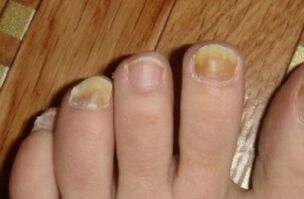 Risk of nail due to fungus
