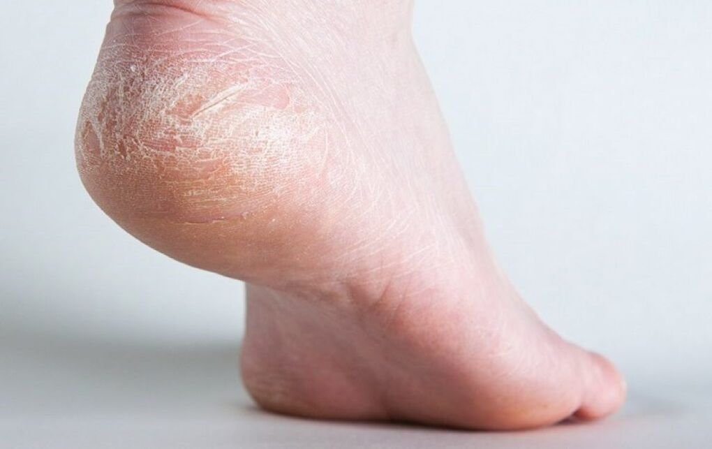 foot fungus